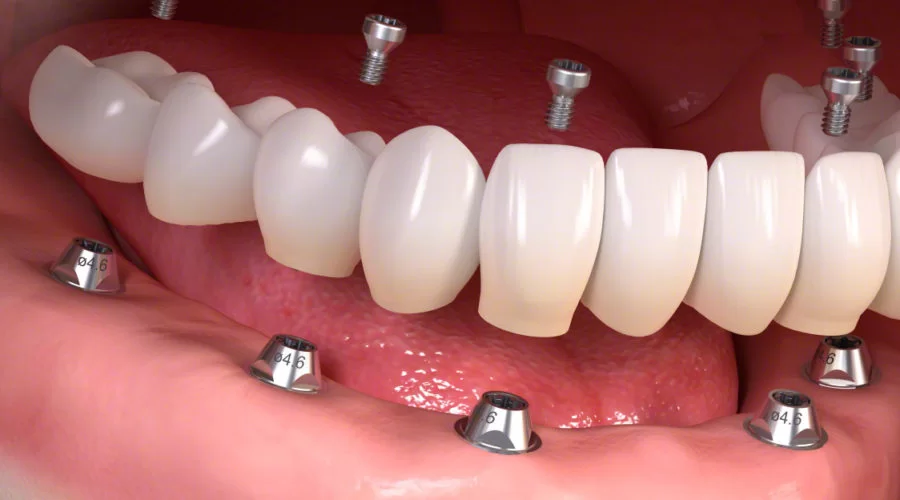 Semi-fixed Dentures